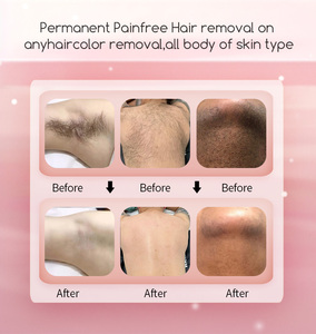 Máquina de Depilación Láser de Diodo Triple Trio de Titanio y Platino de Hielo, 755 810 1064 nm, 808nm, para Clínica de Belleza - Product Image 6