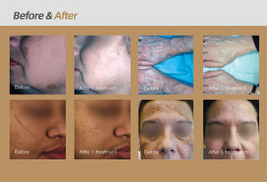 ADSS PICOXBERT <span class=keywords><strong>Pro</strong></span> 360ps Machine de suppression des pigments et des tatouages par laser picoseconde véritable de qualité médicale - Product Image 6