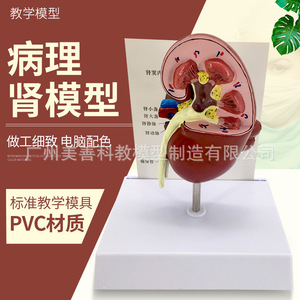 Modelo anatómico de riñón humano, modelo de riñón patológico, especialidad de urología y andrología. - Product Image 3