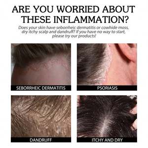 Crème de soin du <span class=keywords><strong>cuir</strong></span> <span class=keywords><strong>chevelu</strong></span> South Moon, crème nettoyante, hydratante et réparatrice pour le <span class=keywords><strong>cuir</strong></span> <span class=keywords><strong>chevelu</strong></span>, soulagement des démangeaisons et de l'eczéma, soin topique - Product Image 3