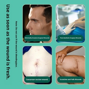 Cinta Adhesiva Médica sin Costuras <span class=keywords><strong>para</strong></span> <span class=keywords><strong>Cerrar</strong></span> <span class=keywords><strong>Heridas</strong></span>, Reducir Cicatrices, Transpirable, Certificada CE, 6cm*100m, Desinfectante con Ozono - Product Image 2
