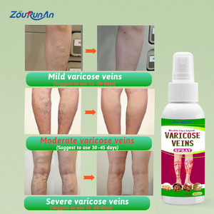 ZouRunAn Aerosol para <span class=keywords><strong>venas</strong></span> varicosas Vasculitis Flebitis <span class=keywords><strong>Piernas</strong></span> <span class=keywords><strong>de</strong></span> araña Calmante Vasos sanguíneos Abultado Enrojecimiento Pierna Cuidado corporal Aerosol para <span class=keywords><strong>venas</strong></span> - Product Image 4