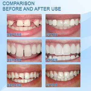 Résine réparation temporaire des dents granulés espaces dentaires dents manquantes dents cassées remplissage de fausses dents <span class=keywords><strong>colle</strong></span> solide moulable soins dentaires - Product Image 5