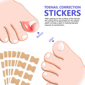 SEFUDUN Adesivi Correttivi per <span class=keywords><strong>Unghie</strong></span> <span class=keywords><strong>Incarnite</strong></span>, Trattamento Traspirante per <span class=keywords><strong>Unghie</strong></span> dei Piedi, Cerotti Correttivi per <span class=keywords><strong>Unghie</strong></span> <span class=keywords><strong>Incarnite</strong></span> - Product Image 6