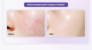 Appareil SPA LED anti-acné corps entier à petites rangées de lumières, soin intensif, réduit les ridules et les pores, renforce et revitalise la peau - Product Image 5