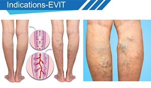 Laser Diode EVLT EVLA 980nm 1470nm 50W 3000ms, liệu pháp cắt bỏ tĩnh mạch bằng laser qua tĩnh mạch cho chứng giãn tĩnh mạch ở chân - Product Image 6
