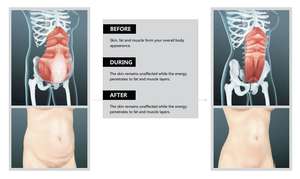 UMS Sculptor เครื่องกระตุ้นกล้ามเนื้อมัลติฟังก์ชั่น,เครื่องกระตุ้นกล้ามเนื้อกายภาพบำบัดสำหรับร้านเสริมสวย - Product Image 6