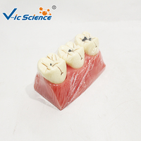Modelo de Caries Dental de 3 Etapas, Ampliado 5 Veces, Dientes Desmontables para Educación en Patología Oral, CE ISO ROHS CNAS