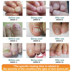 วิตามินอี 30 กรัมสำหรับครีมรักษาเชื้อรา บำรุงเท้า ดูแลเล็บเท้า กำจัดเชื้อรา บำรุงเล็บ แก้อาการเชื้อราที่เล็บ - Product Image 4