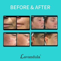 PZLASER Salon de beauté, meilleur laser Thulium 1927nm, gynécologie, lifting du visage, élimination de l'acné, machine à laser fractionné non ablatif
