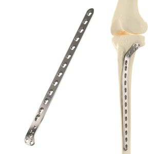 Placca Tibiale Lattale Proximale Bloccabile CANWELL, Impianto Ortopedico per Trauma, Placca Ossea Ospedaliera con Vite da 5.0mm, Produttore Ortopedico - Product Image 1