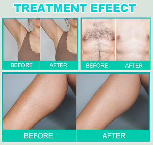 Appareil d'épilation à l'aiguille par électrolyse permanente pour tous les types de cheveux et couleurs de peau - Product Image 6