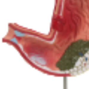 Modèle de Pathologie Gastrique D021F/D021G pour l'enseignement et l'apprentissage de l'Anatomie en Sciences Médicales pour la Formation des Infirmières - Product Image 6