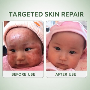 YIHE-HEALTH <span class=keywords><strong>crema</strong></span> riparatrice per la pelle <span class=keywords><strong>crema</strong></span> per dermatite da pannolino Eczema nei bambini - Product Image 3