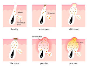 Couverture d'acné de coeur de laser Acné hydrocolloïde absorbant Zits et imperfections Pimple Patch pour le visage - Product Image 6