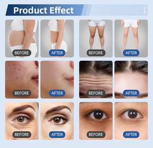 เครื่องนวดกระชับสัดส่วน 5in1 40k แบบดูดสุญญากาศ ยกกระชับผิว - Product Image 5