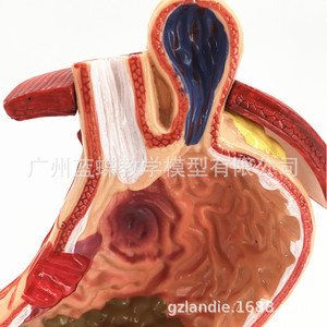 Modelo anatómico gástrico, modelo de estómago con enfermedades, modelo de demostración de enfermedades gástricas, modelo de estómago patológico, humano - Product Image 3