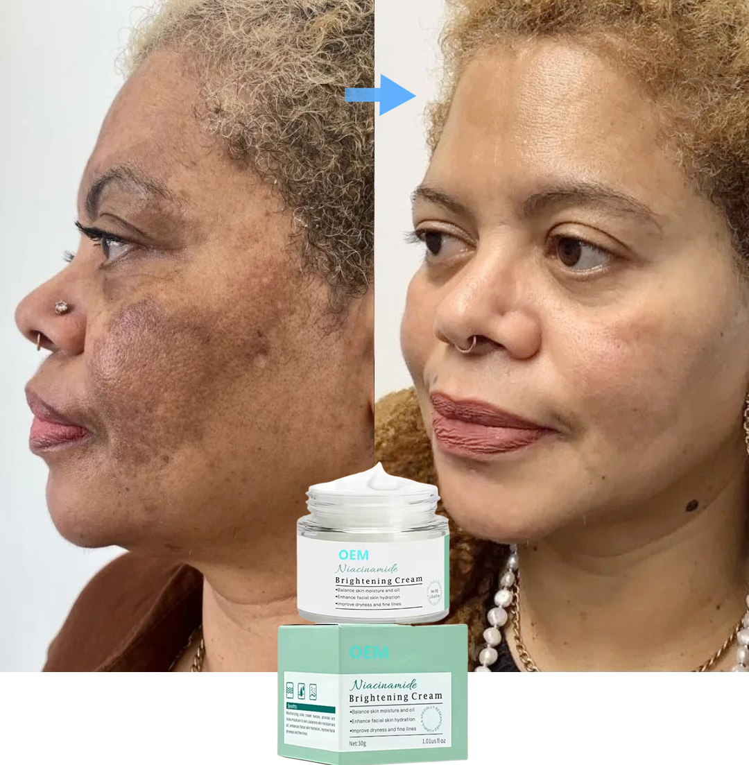 Customized Skin Lightening Cream Private Logo Natural Aloe Vera Based  Effective Removing Black Spots Safe Whitening Side Effects| Alibaba.com