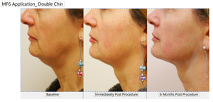 Appareil de raffermissement cutané du <span class=keywords><strong>visage</strong></span> et du corps par ultrasons focalisés de haute intensité 7D, <span class=keywords><strong>laser</strong></span> Hiifu, élimination des rides, 7 cartouches, machine d'élimination de la graisse - Product Image 5