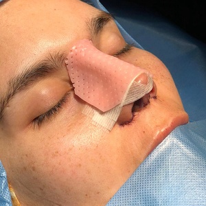 Attelle nasale externe thermoplastique CE ISO13485 <span class=keywords><strong>Aquaplast</strong></span> pour la chirurgie plastique moulée du nez Rhinoplastie Fracture Rehabilitation - Product Image 3