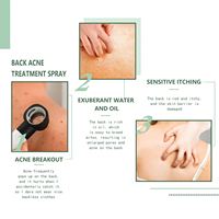 Sérum de soin de la peau Jaysuing pour atténuer les marques d'acné, traitement de l'acné du dos et du torse, sérum pour la fermeture des pores, spray apaisant pour la peau, soin de la peau GG