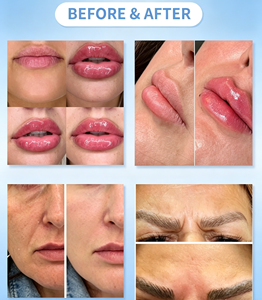 Gel injectable stérile de 10cc à l'acide hyaluronique réticulé pour l'élimination modérée des rides et l'amélioration des lèvres - Product Image 5