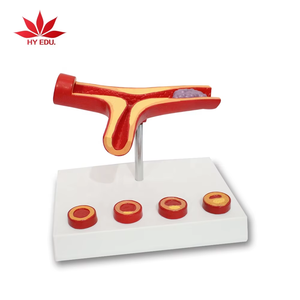 Anatomie humaine Artère et vaisseaux sanguins athérosclérose Modèle de <span class=keywords><strong>pathologie</strong></span> thrombus médical - Product Image 2