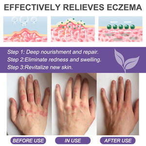 กลากวิโอลาครีมบรรเทาอาการผื่นแดงผื่น<span class=keywords><strong>คัน</strong></span>ผื่น<span class=keywords><strong>คัน</strong></span>ผื่น<span class=keywords><strong>คัน</strong></span>บนใบหน้าและร่างกายทันที24กรัม - Product Image 5