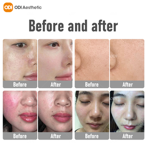 Đa chức năng xách tay Cách Mạng oxy hyperbaric mặt máy bay phản lực Peel oxy phun máy trị liệu Oxy Dome - Product Image 6