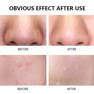 Private Label 30ML 1% <strong>Benzoyl</strong> <strong>Peroxide</strong> Gel Moisturizing Anti-Wrinkle Oil Control Spot Solution For Face Acne Whitening Facial - Product Image 5
