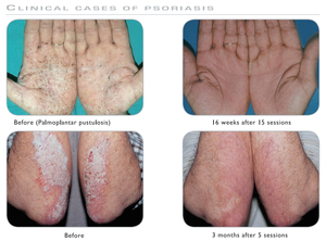 CE diakui Kernel medis KN-5000D Vitiligo <span class=keywords><strong>Psoriasis</strong></span> perawatan 308nm Excimer Laser Vitiligo <span class=keywords><strong>Psoriasis</strong></span> pengobatan - Product Image 6