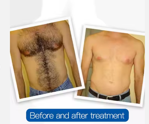 Appareil laser diode de bureau 808 nm pour l'épilation, avec longueurs d'onde 755, 1064 et 940 nm, pour clinique esthétique - Product Image 6