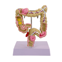 Modelo patológico de intestino grueso, lesiones gastrointestinales, modelo anatómico, enfermedad intestinal, modelo de lesiones de colon humano