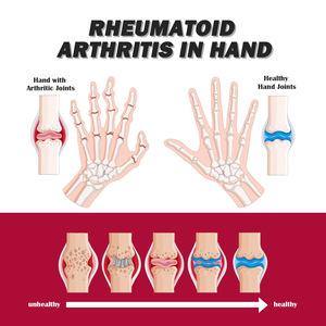 La férula tibial alivia el <span class=keywords><strong>dolor</strong></span> en las manos, pies y pies detrás <span class=keywords><strong>del</strong></span> <span class=keywords><strong>cuello</strong></span>, loción Nanyue, crema para tratamiento de articulaciones y músculos - Product Image 6