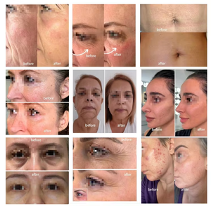 Dispositivo de Tratamiento Cutáneo con Plasma Frío, el Más Vendido, para Eliminación del Acné y Limpieza con Oxígeno, con Tecnología de Plasma - Product Image 6