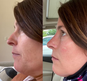 Hereme Non-chirurgical 1ml 2ml 3ml 5ml Gel d'<span class=keywords><strong>acide</strong></span> <span class=keywords><strong>hyaluronique</strong></span> réticulé pour remodelage nasal, lifting facial et <span class=keywords><strong>injection</strong></span> de volume nasal - Product Image 6