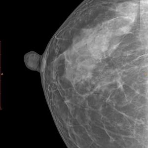 Equipo médico 10 ''* 12'' Detector de panel plano de mama digital inalámbrico X Ray DR Detector de panel plano Detector de mamografía - Product Image 6