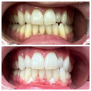 <span class=keywords><strong>Kit</strong></span> de gel de <span class=keywords><strong>blanchiment</strong></span> des dents au peroxyde d'hydrogène <span class=keywords><strong>Pro</strong></span> Dental 35% avec double seringue Meilleurs résultats Le gel de <span class=keywords><strong>blanchiment</strong></span> des dents élimine les taches des années - Product Image 2