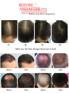 Professional Scalp <b>Microscope</b> Camera - Portable Hair Follicle Detector for Hair Loss Treatment Scalp Care & Analysis - Product Image 6