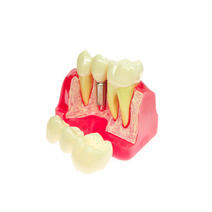Modèle dentaire, modèle pédagogique buccal, modèle d'implant dentaire détachable, modèle de communication médecin-patient, modèle de soins dentaires - Product Image 1