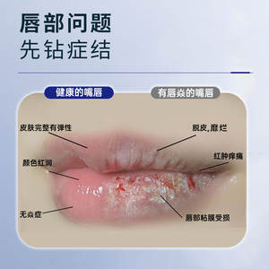 ลิปบาล์มเจลทางการแพทย์แบบกำหนดเอง 15 กรัม ซ่อมแซมริมฝีปากแห้งแตก ริมฝีปากเป็นแผล ริมฝีปากลอกเป็นขุย สำหรับเด็ก ทารก ผู้ใหญ่ ผู้หญิง - Product Image 2