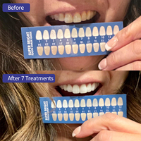Kit Profesional de Blanqueamiento Dental, Elimina Manchas de Café, Té y Humo, Aclara los Dientes