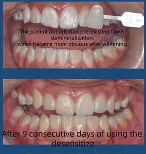 Gel Desensibilizante Dental 4 en 1, Desensibilización, Anticaries, Antibacteriano, Fortalece el Esmalte Dental - Product Image 3