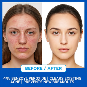 Limpiador Facial en Espuma Hidratante y Purificante de Limpieza Profunda con 4% de Peróxido de Benzoilo para Venta al por Mayor - Product Image 2
