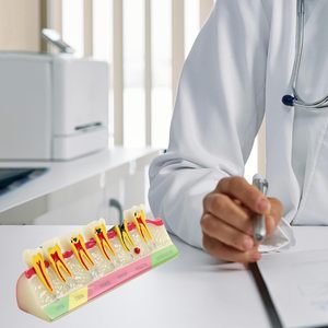 Dental <b>Teeth</b> Model 6-Stage Caries Development Educational Model for Periodontal Disease Patient Display - Product Image 4