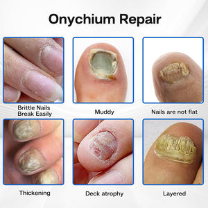 Patch de soin des ongles à l'huile d'arbre à thé naturelle, anti-fongique, utilisation nocturne pour le traitement des champignons, produit de réparation des ongles - Product Image 4