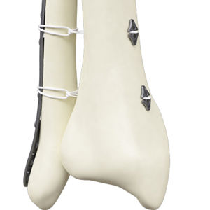 CANWELL Artroscopia Botón Acromio Clavicular Articulación Botón AC Reparación Botón Ortopédico Medicina Deportiva - Product Image 2