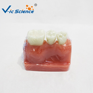 Modèle d'implant triple couronne en argent ; modèle de démonstration de communication dentaire médecin-patient - Product Image 3