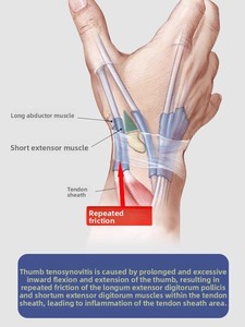 Мягкий защитный напальчник-фиксатор для большого пальца, спица-шина для суставов при болях - Product Image 3