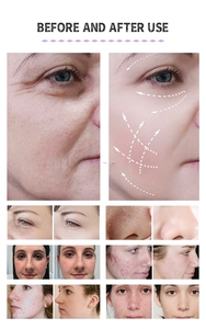 Vente directe - Nettoyage du visage multifonctionnel 8 en 1 - Hydro-jet d'eau et d'oxygène - Analyse de la peau - Microdermabrasion - Soins du visage en spa - Product Image 5